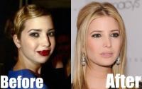 Ivanka Trump ennen ja jälkeen plastiikkakirurgian
